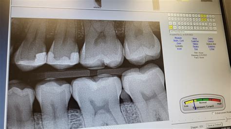 r/askdentists|1512 best r/askdentists images on Pholder .